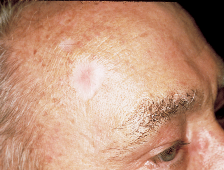 what-is-non-melanoma-skin-cancer-haleroadmedical